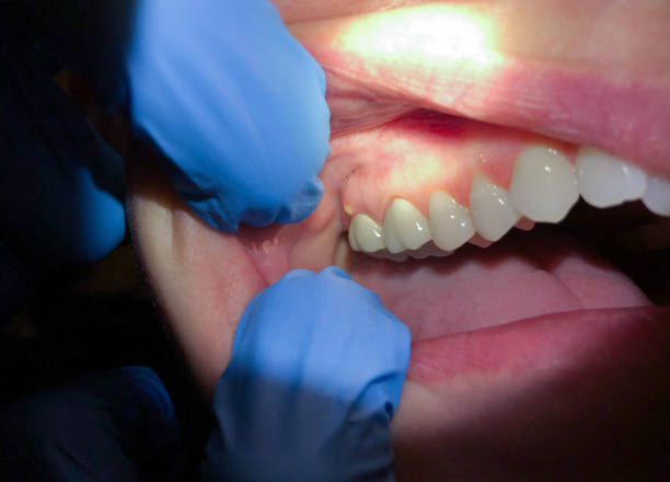 Best Emergency Dentist for Lost Fillings or Crowns in Churchill, MT